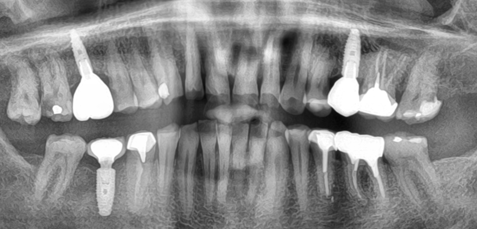 Pano dent 20251009